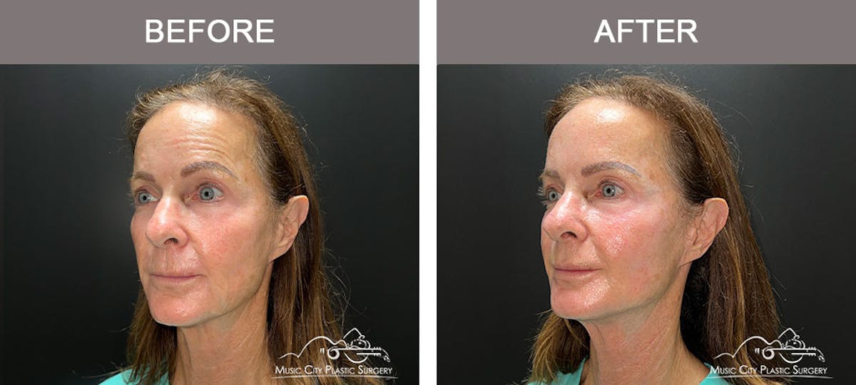 Thread Lifts Before & After Gallery - Patient 179398974 - Image 4