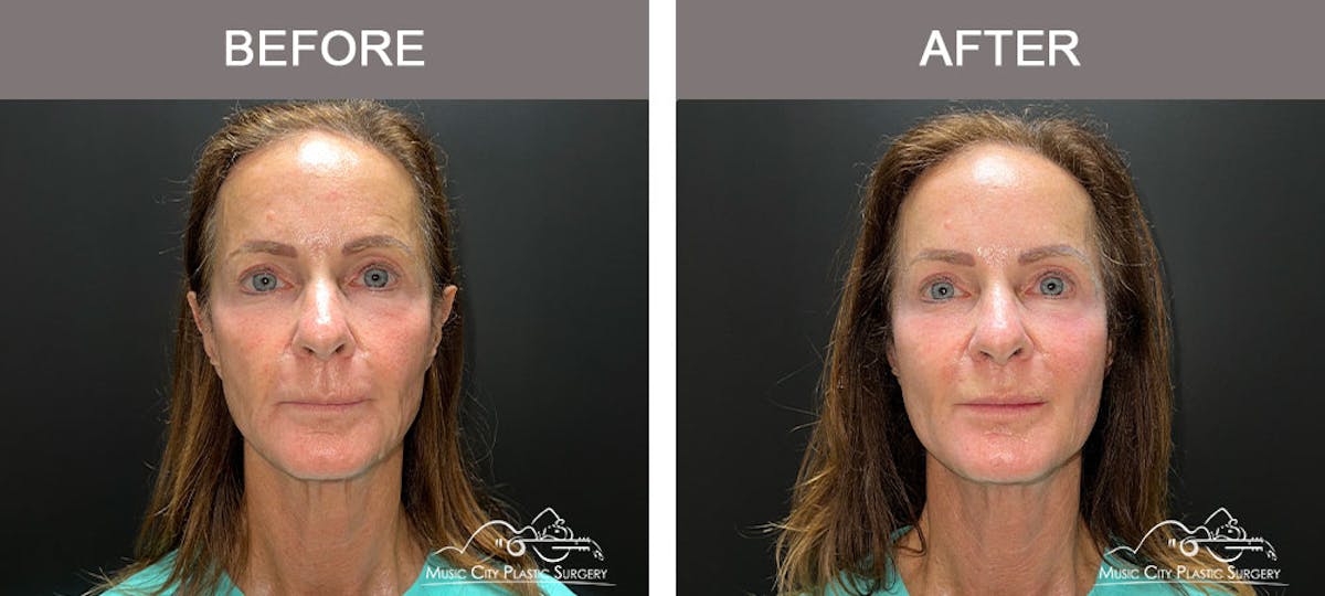 Thread Lifts Before & After Gallery - Patient 179398974 - Image 1