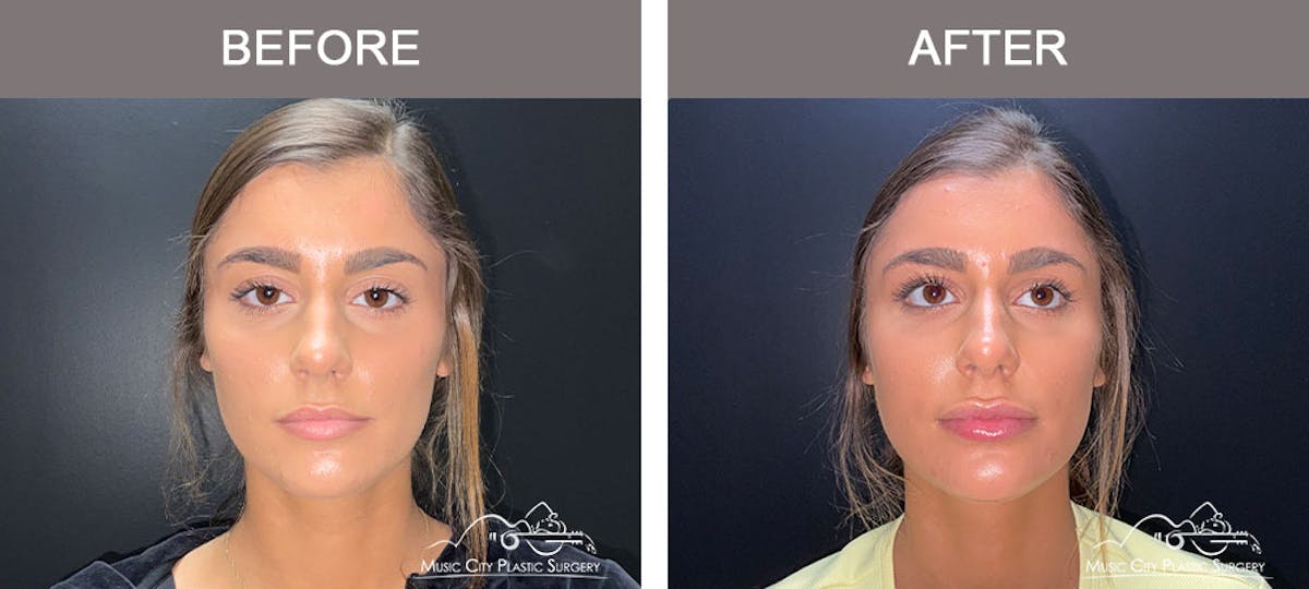 Dermal Fillers Before & After Gallery - Patient 179398978 - Image 1