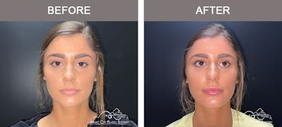 Dermal Fillers Before & After Gallery - Patient 179398978 - Image 1