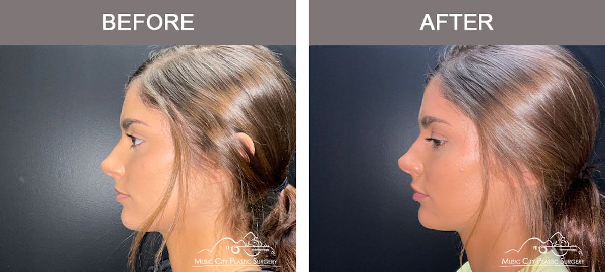 Dermal Fillers Before & After Gallery - Patient 179398978 - Image 2