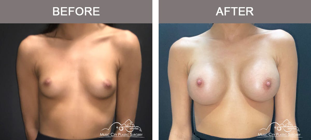Breast Augmentation Before & After Gallery - Patient 179398986 - Image 1