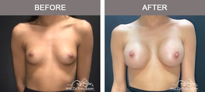 Breast Augmentation Before & After Gallery - Patient 179398986 - Image 1