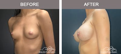 Breast Augmentation Before & After Gallery - Patient 179398986 - Image 2