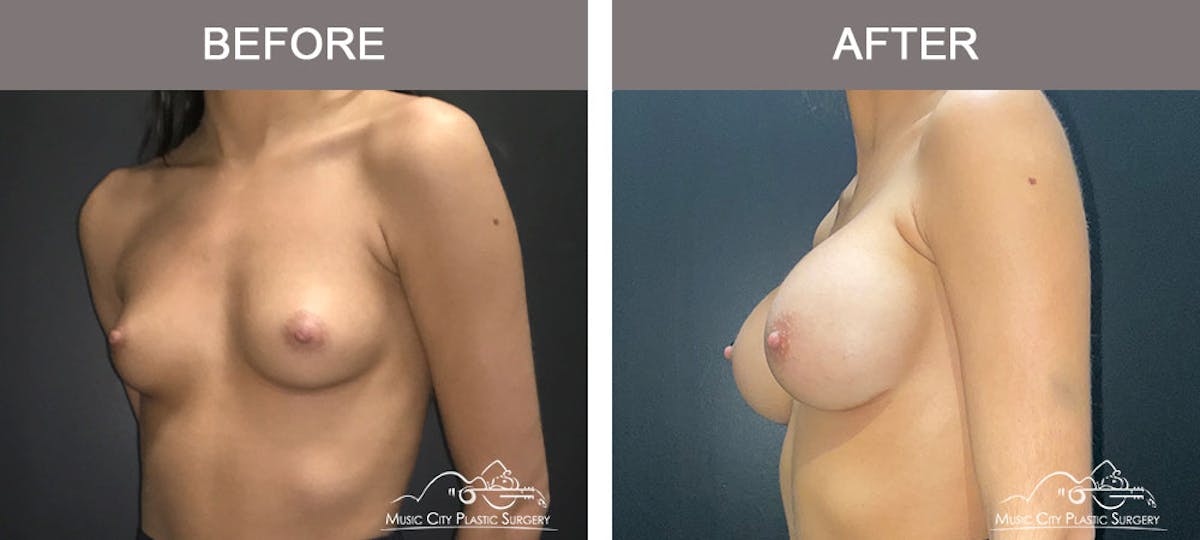 Breast Augmentation Before & After Gallery - Patient 179398986 - Image 2