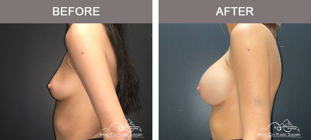Breast Augmentation Before & After Gallery - Patient 179398986 - Image 3