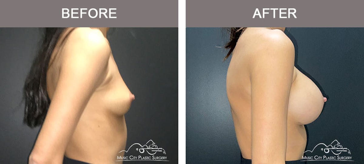 Breast Augmentation Before & After Gallery - Patient 179398986 - Image 4