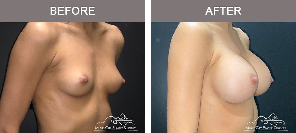 Breast Augmentation Before & After Gallery - Patient 179398986 - Image 5