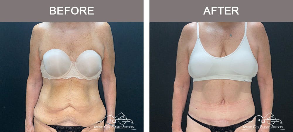 Body Lift Before & After Gallery - Patient 179398992 - Image 1