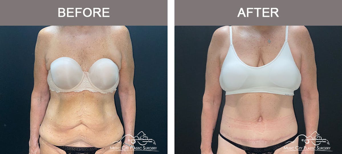 Belt Lipectomy/Body Lift Before & After Gallery - Patient 179398992 - Image 1