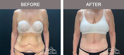 Belt Lipectomy/Body Lift Before & After Gallery - Patient 179398992 - Image 1