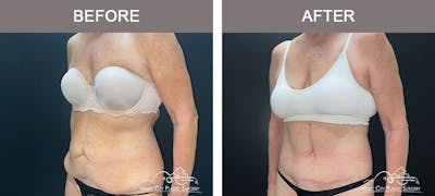 Body Lift Before & After Gallery - Patient 179398992 - Image 2