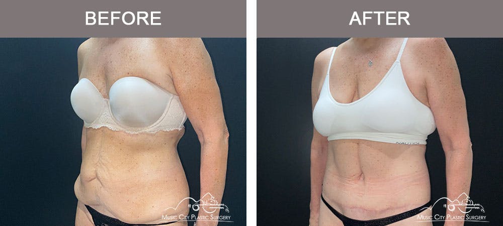 Body Lift Before & After Gallery - Patient 179398992 - Image 2