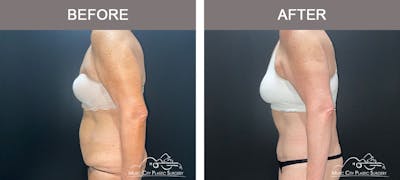 Body Lift Before & After Gallery - Patient 179398992 - Image 3