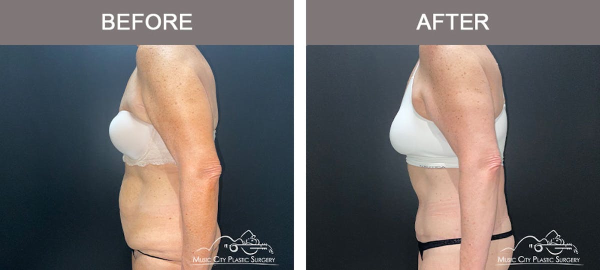 Body Lift Before & After Gallery - Patient 179398992 - Image 3