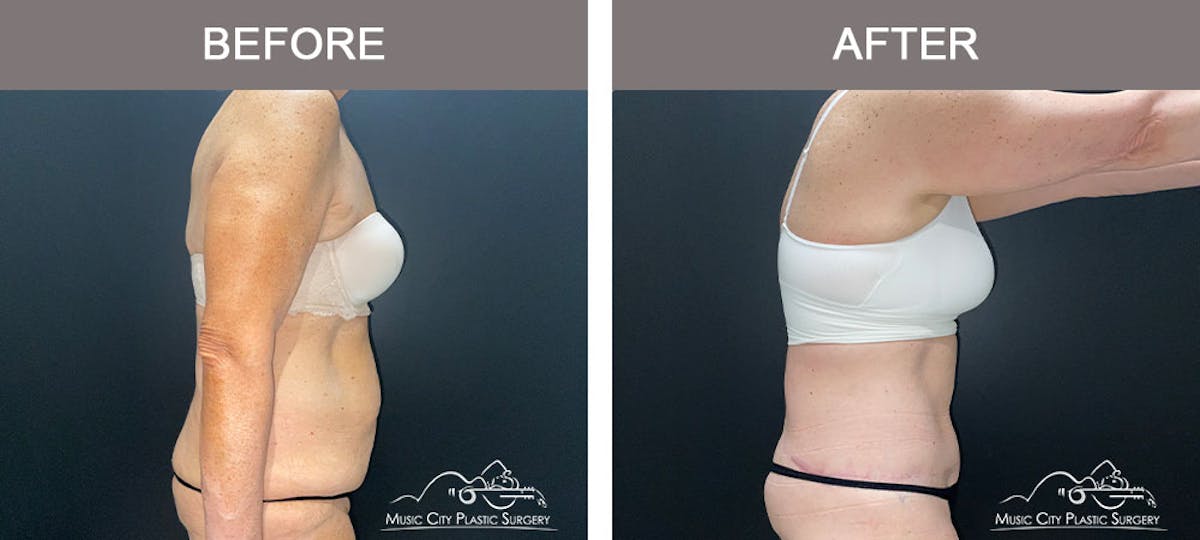 Body Lift Before & After Gallery - Patient 179398992 - Image 4