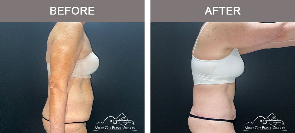 Body Lift Before & After Gallery - Patient 179398992 - Image 4