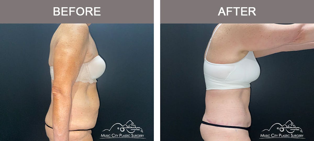 Belt Lipectomy/Body Lift Before & After Gallery - Patient 179398992 - Image 4