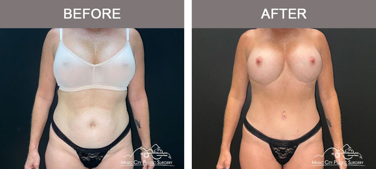 Liposuction Before & After Gallery - Patient 183232114 - Image 1