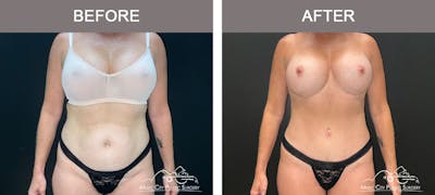Liposuction Before & After Gallery - Patient 183232114 - Image 1
