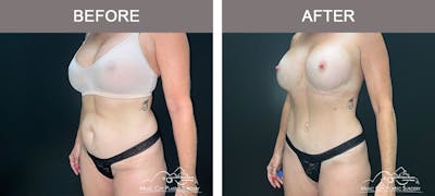 Liposuction Before & After Gallery - Patient 183232114 - Image 2