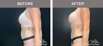 Liposuction Before & After Gallery - Patient 183232114 - Image 3