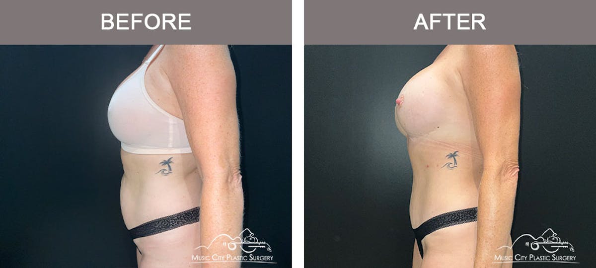 Liposuction Before & After Gallery - Patient 183232114 - Image 3
