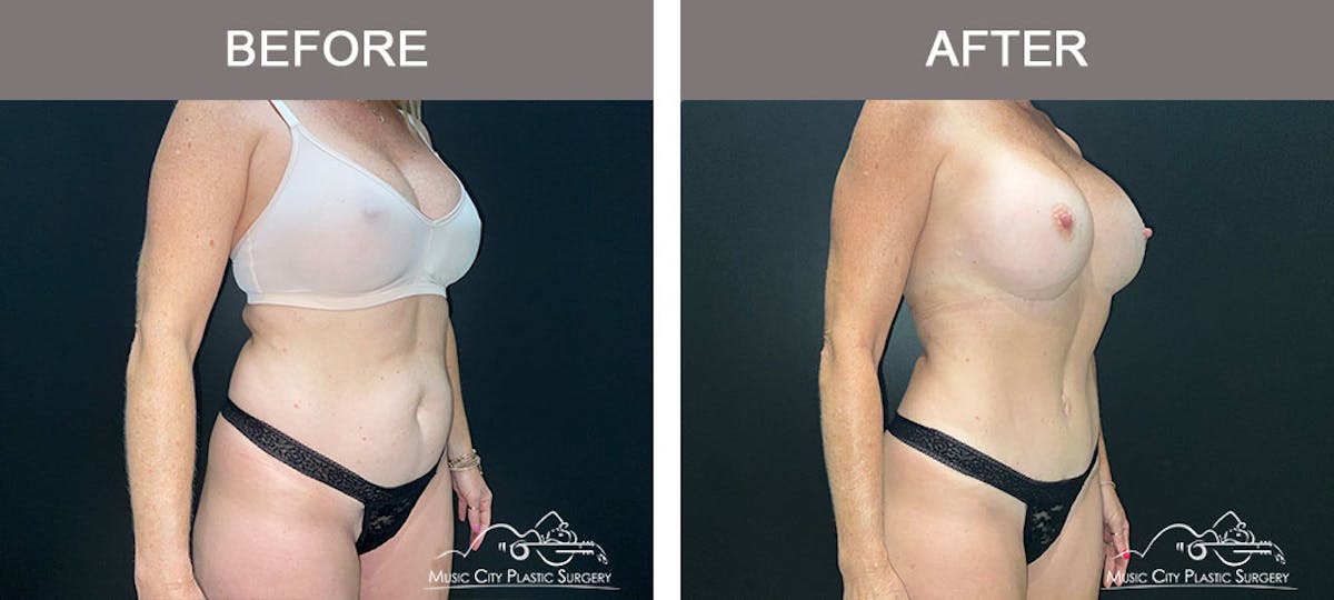 Liposuction Before & After Gallery - Patient 183232114 - Image 4
