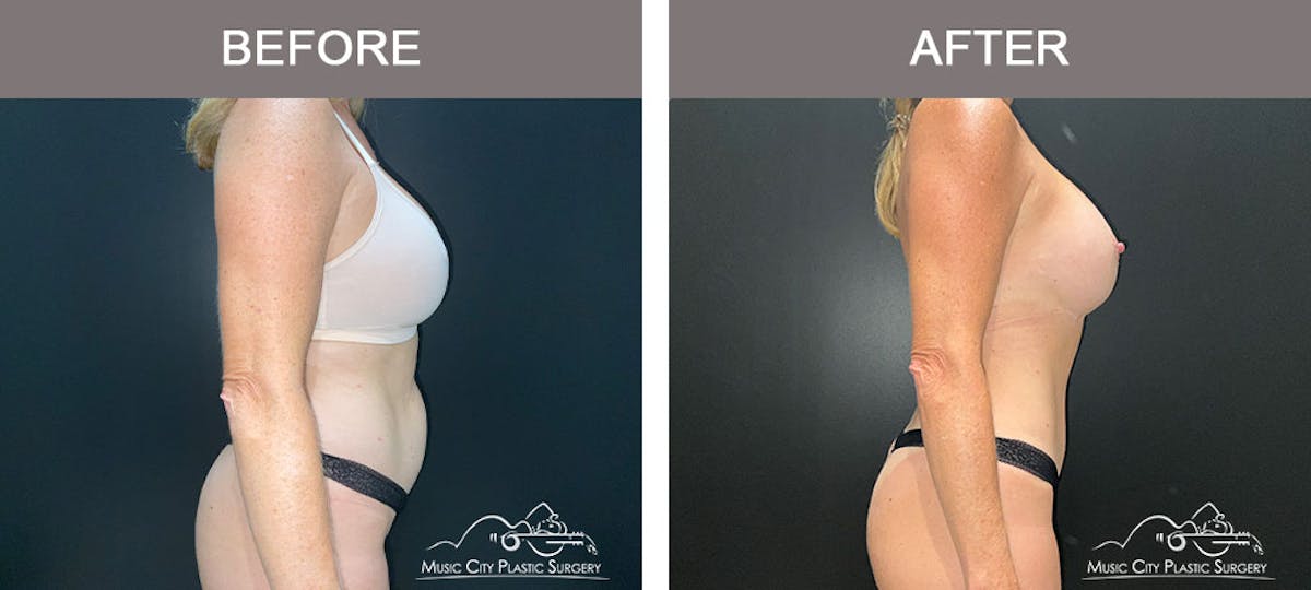 Liposuction Before & After Gallery - Patient 183232114 - Image 5