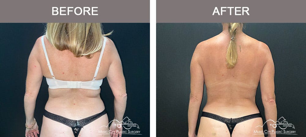 Liposuction Before & After Gallery - Patient 183232114 - Image 6