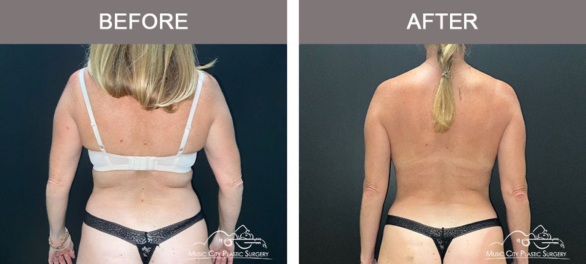 Liposuction Before & After Gallery - Patient 183232114 - Image 6