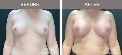 Breast Augmentation Before & After Gallery - Patient 183232120 - Image 1
