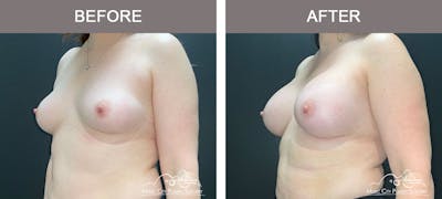 Breast Augmentation Before & After Gallery - Patient 183232120 - Image 2