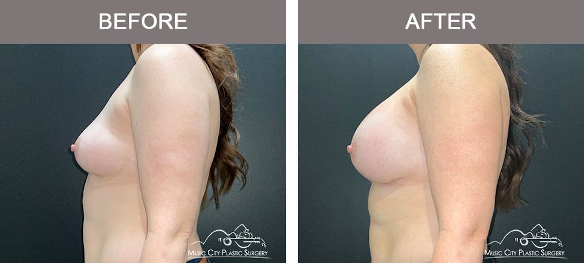 Breast Augmentation Before & After Gallery - Patient 183232120 - Image 3