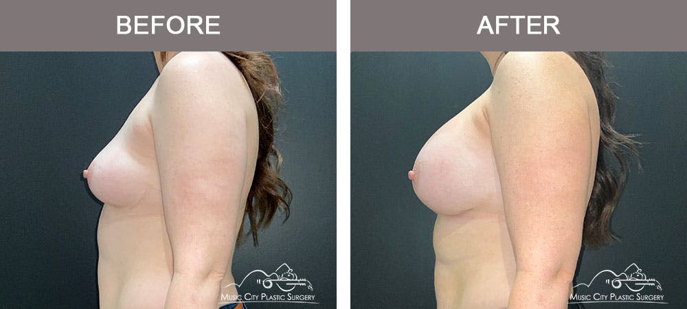 Breast Augmentation Before & After Gallery - Patient 183232120 - Image 3