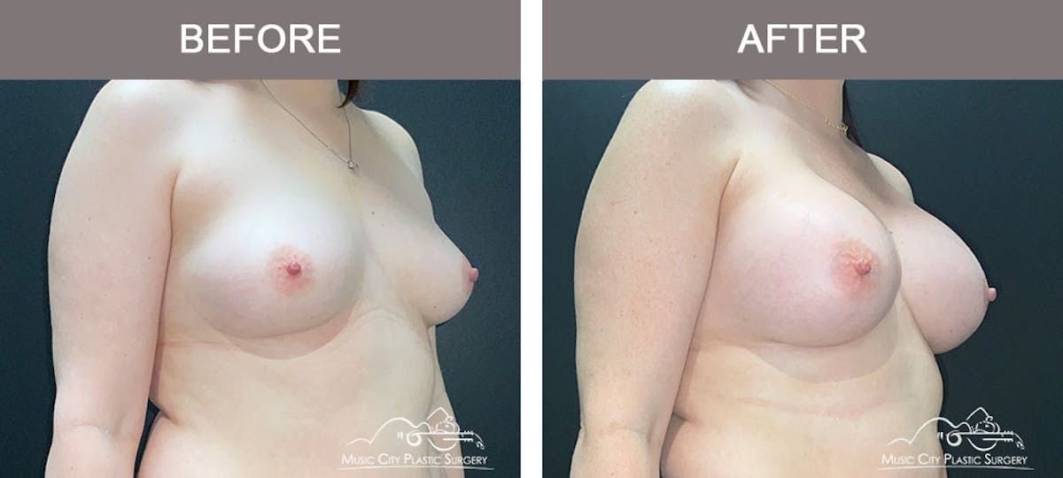 Breast Augmentation Before & After Gallery - Patient 183232120 - Image 4
