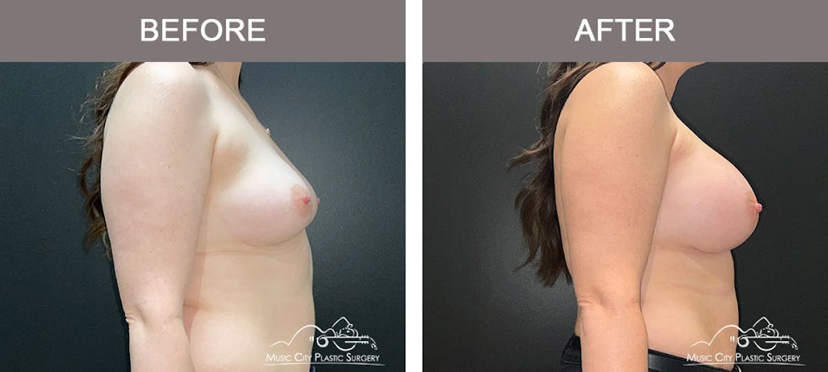 Breast Augmentation Before & After Gallery - Patient 183232120 - Image 5