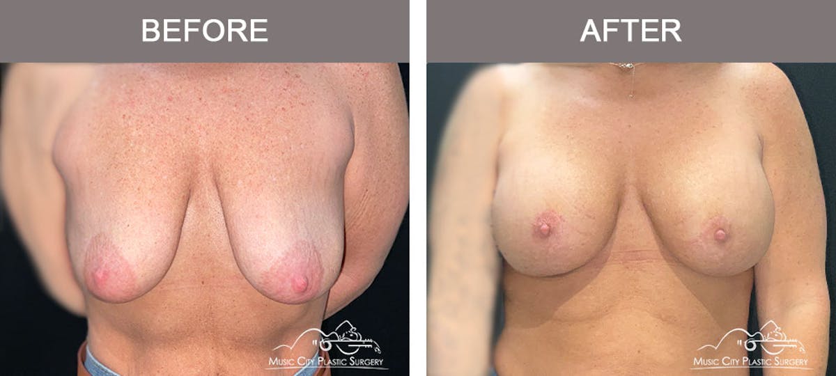 Breast Augmentation Before & After Gallery - Patient 183232149 - Image 1