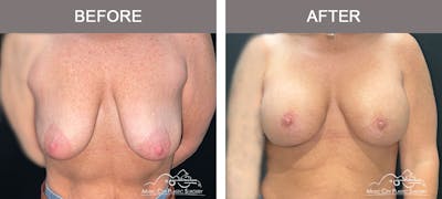 Breast Lift Before & After Gallery - Patient 183232145 - Image 1