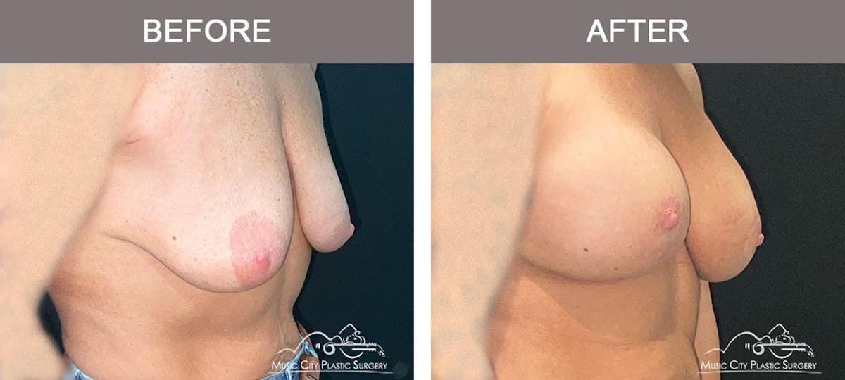 Breast Lift Before & After Gallery - Patient 183232145 - Image 2