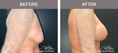 Breast Augmentation Before & After Gallery - Patient 183232149 - Image 3