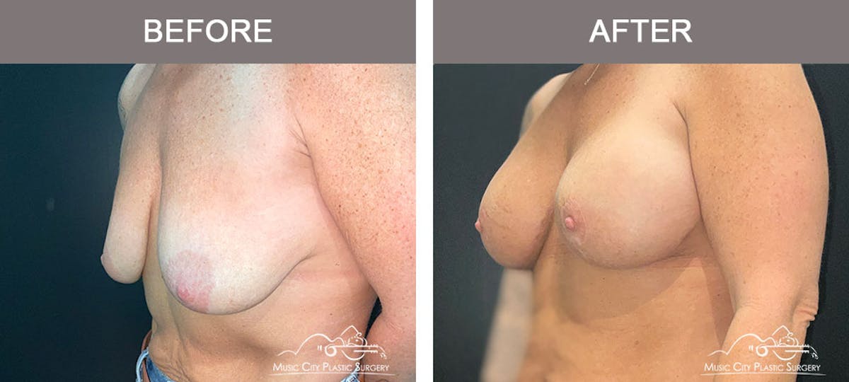 Breast Lift Before & After Gallery - Patient 183232145 - Image 4