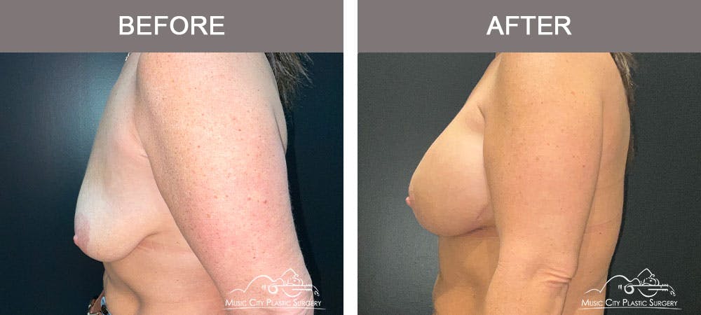 Breast Augmentation Before & After Gallery - Patient 183232149 - Image 5