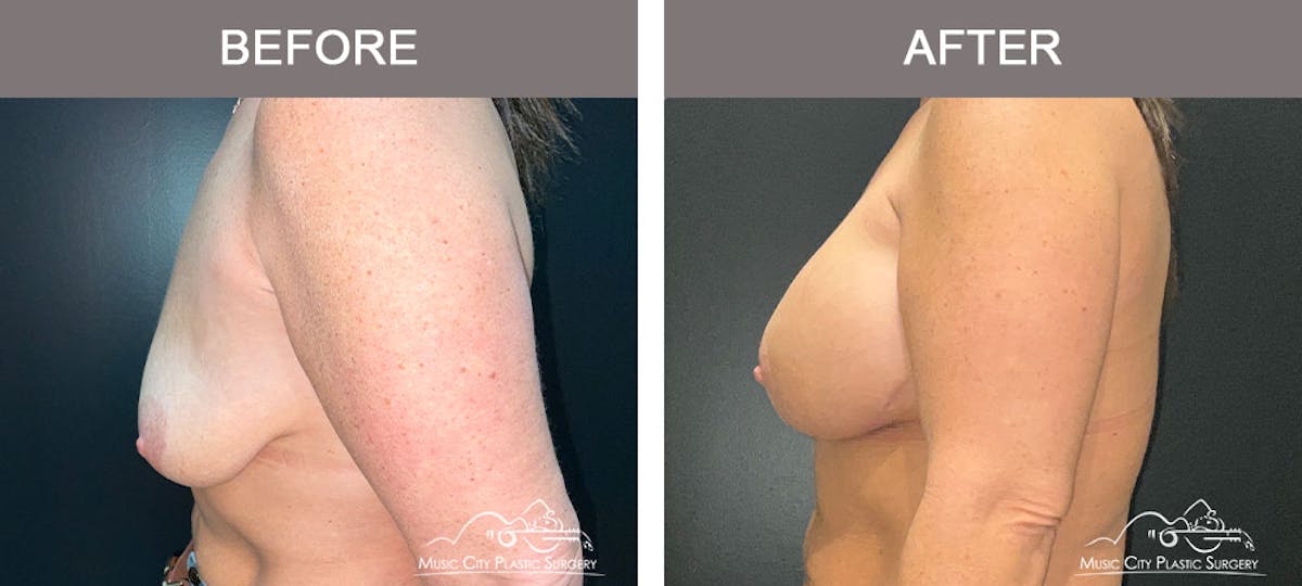 Breast Lift Before & After Gallery - Patient 183232145 - Image 5