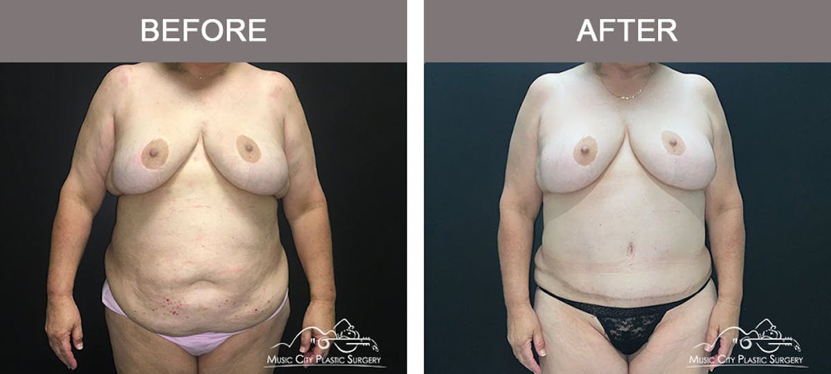 Abdominoplasty Before & After Gallery - Patient 183233240 - Image 1