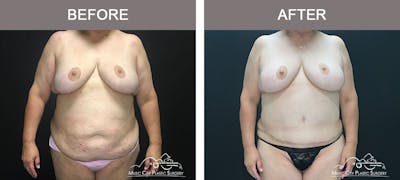 Abdominoplasty Before & After Gallery - Patient 221978 - Image 1