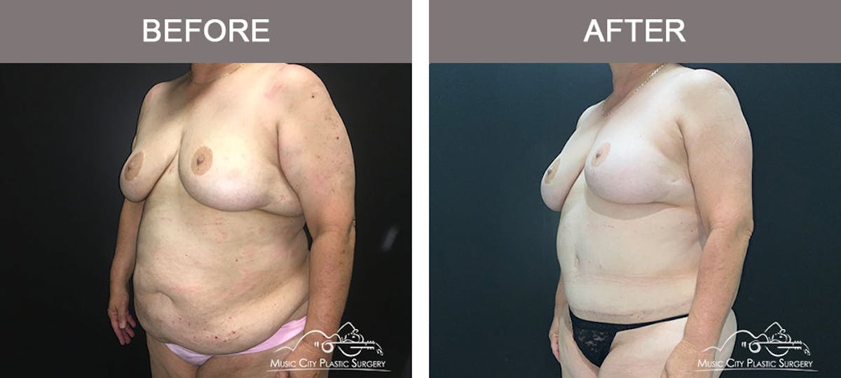 Abdominoplasty Before & After Gallery - Patient 221978 - Image 2