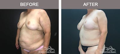 Abdominoplasty Before & After Gallery - Patient 221978 - Image 2