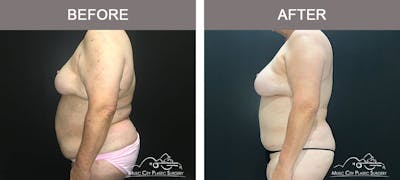 Abdominoplasty Before & After Gallery - Patient 221978 - Image 3