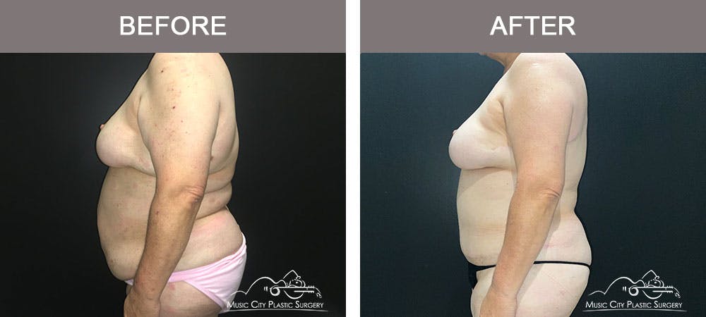 Abdominoplasty Before & After Gallery - Patient 183233240 - Image 3